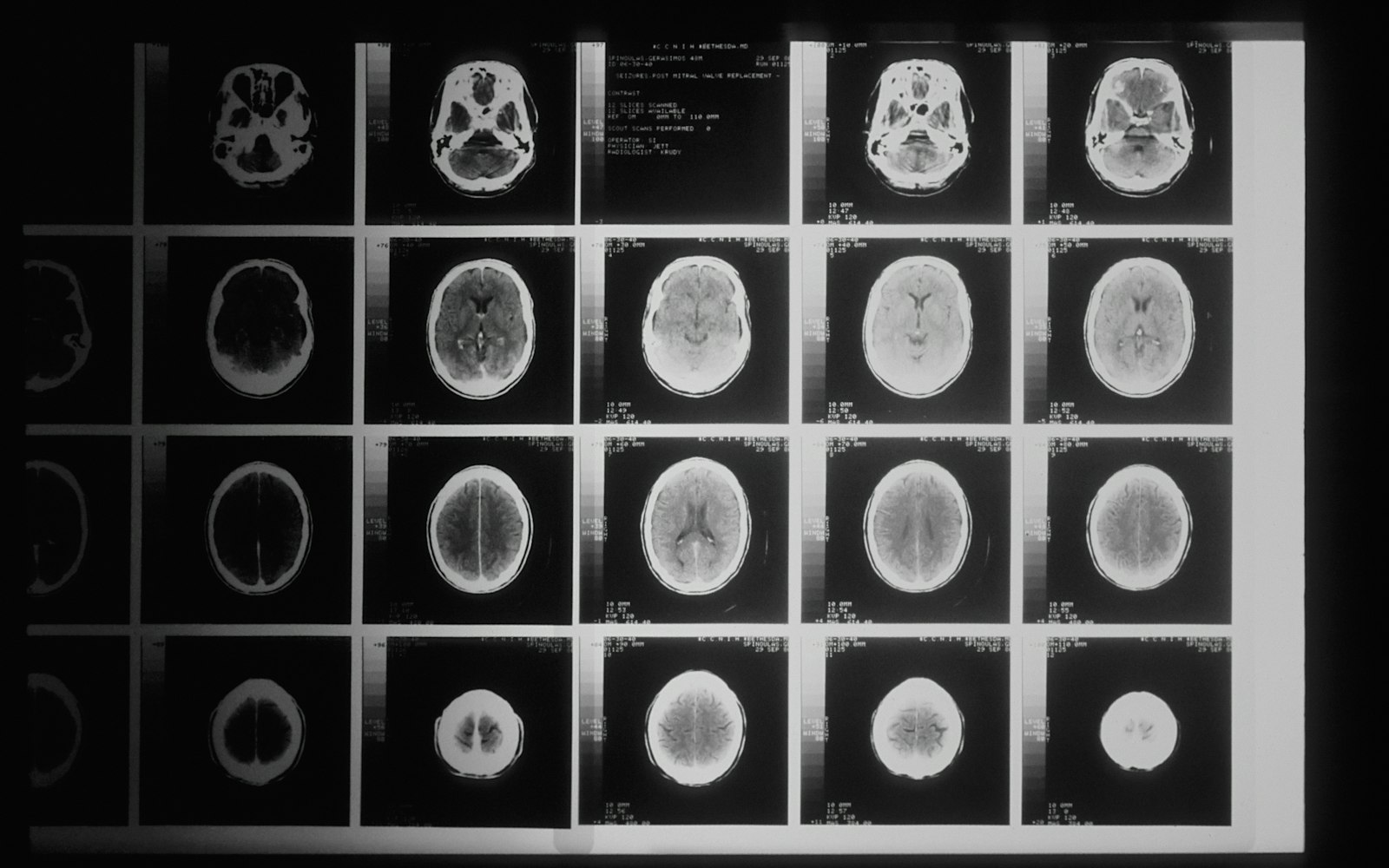 Grid of brain CT scan images on a light board, the kind of imaging a Queens brain injury lawyer reviews
