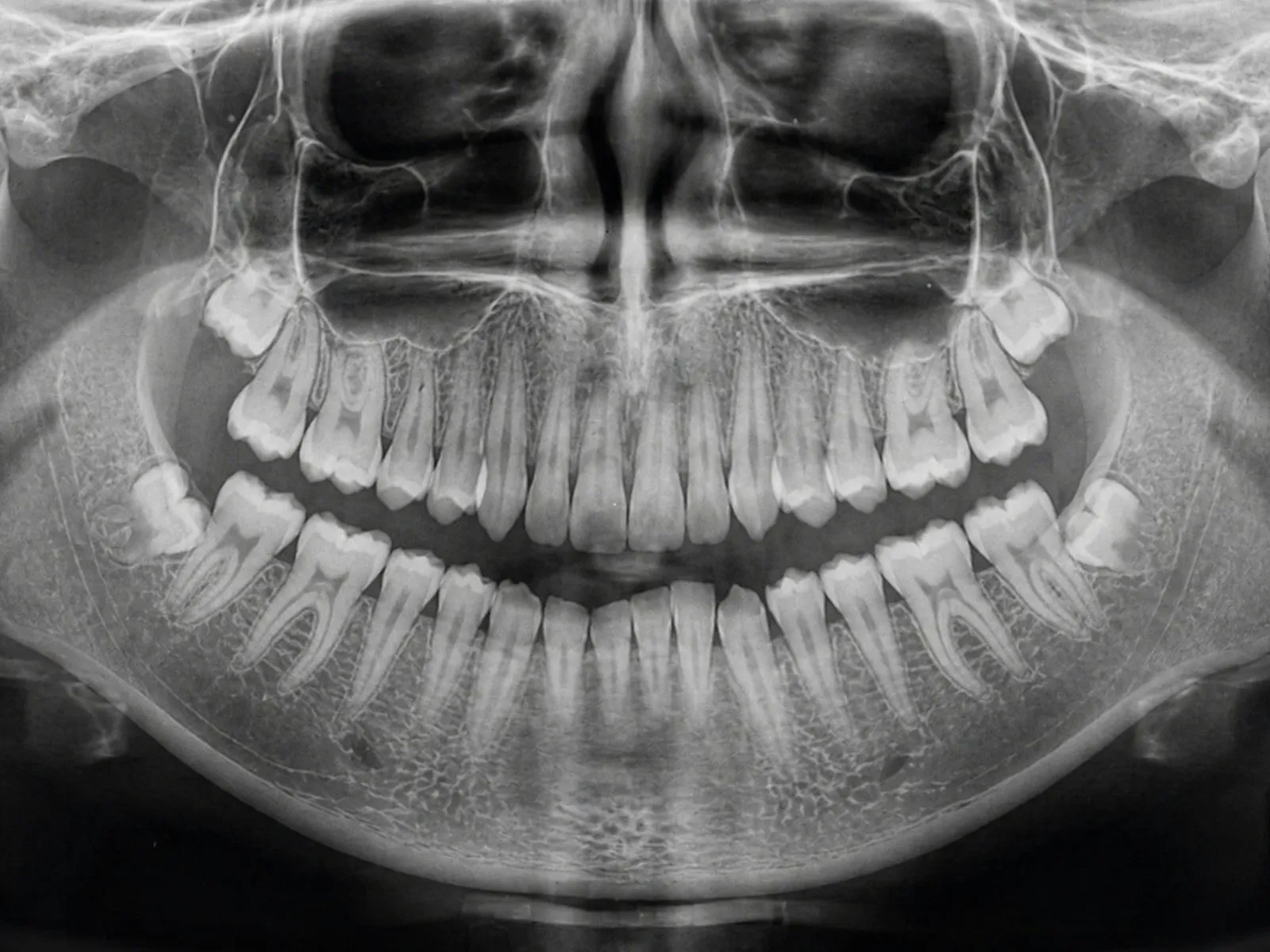 Panoramic dental x-ray showing both jaws and all teeth, the kind of imaging a dental injury lawyer reviews