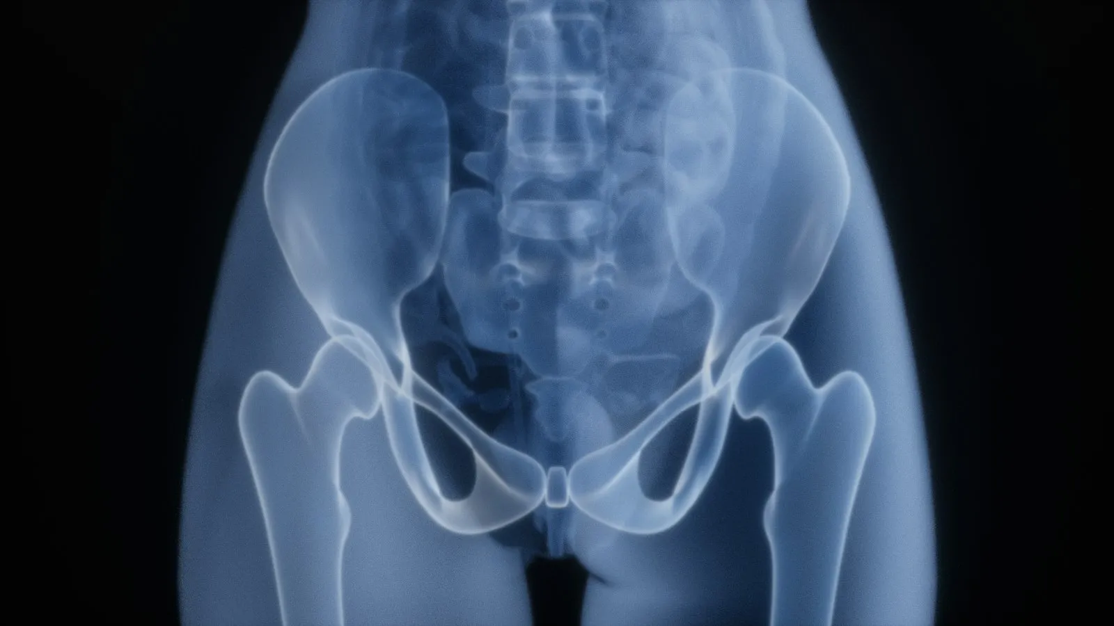 X-ray image of the pelvis and both hip joints reviewed in a hip injury lawyer's case file