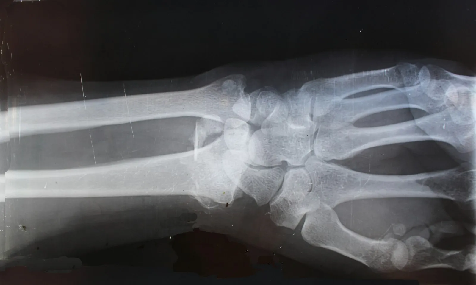Motor Vehicle Accident Lawyer in Bellerose – x-ray image showing an injury