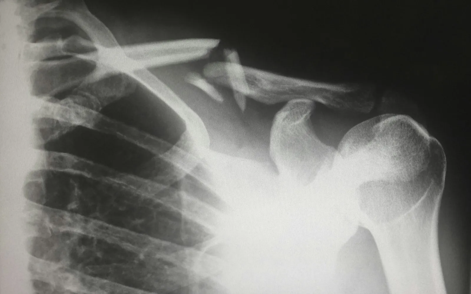 X-ray of a human shoulder joint and collarbone illustrating injuries a shoulder injury lawyer reviews